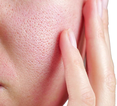 Hydrafacial Treatment